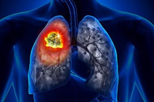 روغن کانابیدیول می تواند تومورهای سرطان ریه را کوچک کند