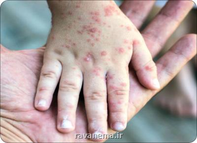 دوره پنهان سرخک ۲ هفته است