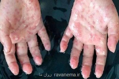 مراقبت مرزی برای مقابله با آبله میمون