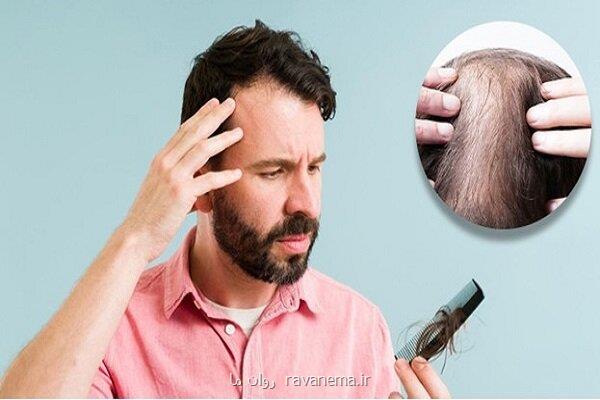 شایع ترین علت ریزش مو چیست؟