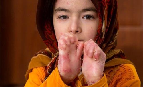 پانسمان های تخصصی بیماران پروانه ای تحویل گردید
