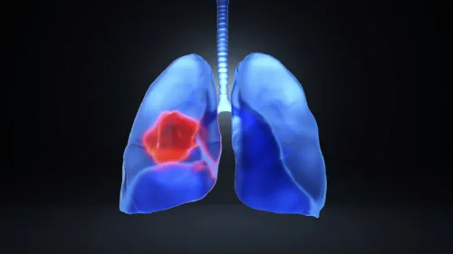 کشف عامل کلیدی توسعه سرطان ریه در ابتدای کار