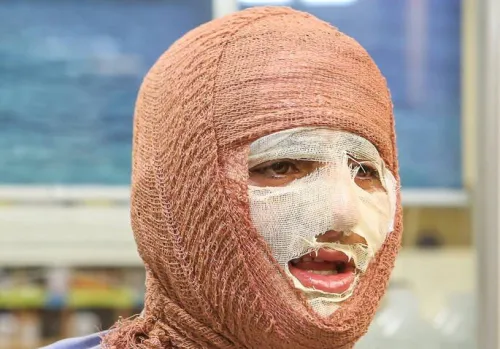 سالانه حدود 300 هزار نفر به مراکز سوختگی کشور مراجعه می کنند