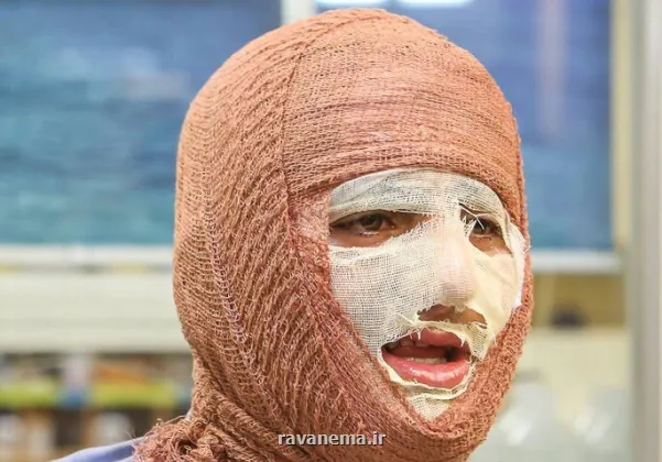 سالانه حدود 300 هزار نفر به مراکز سوختگی کشور مراجعه می کنند
