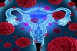 شیوع سندروم تخمدان در زنان و دختران، اختلال در باروری