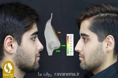 جراحی بینی با قالب كنترلی