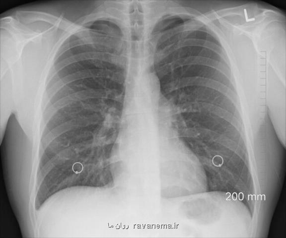 همه چیز درباره پیشگیری، تشخیص و درمان سرطان ریه
