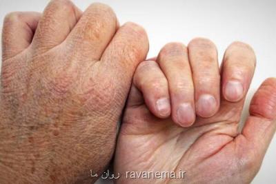 ۹۵ درصد مردم هیچ گاه جذام نمی گیرند